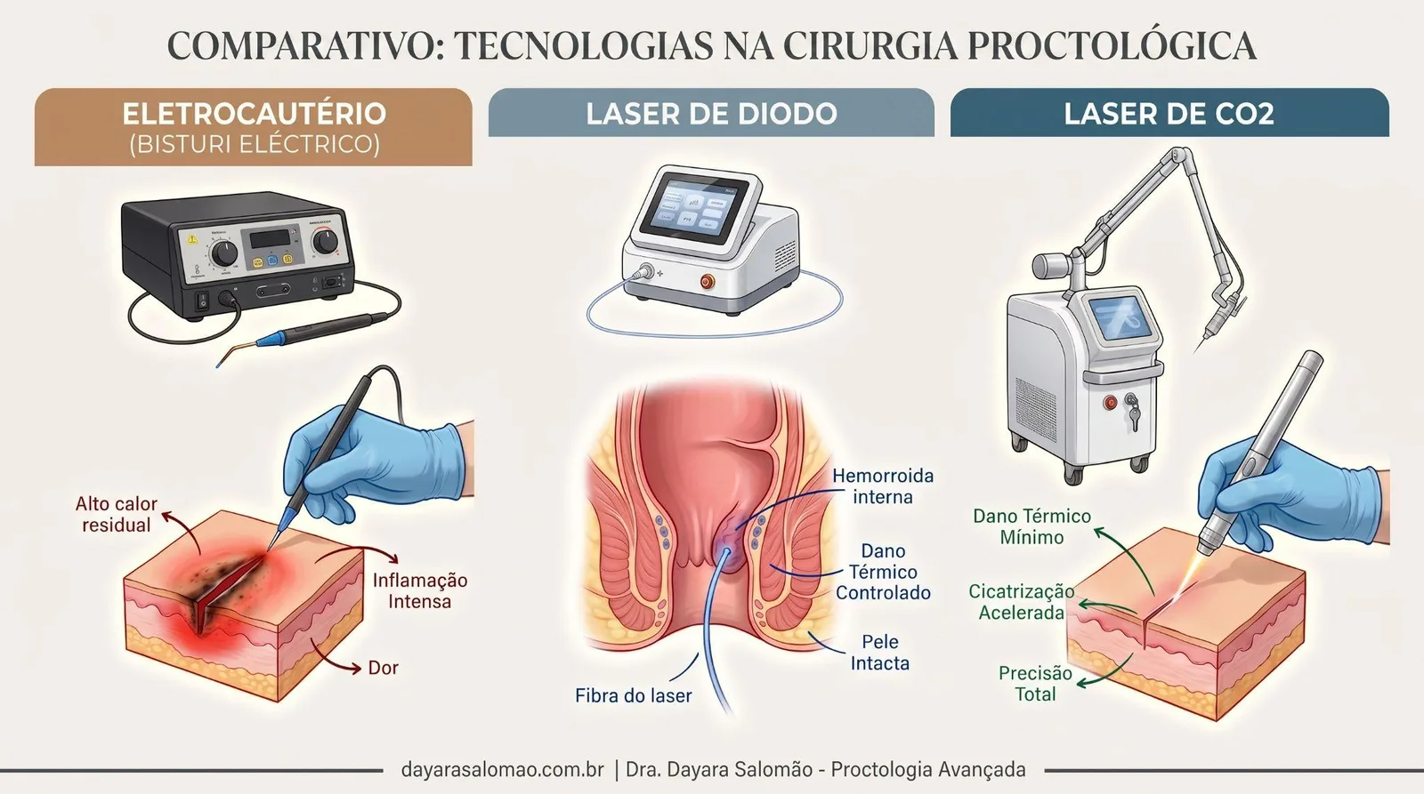 Comparativo das tecnologias na cirurgia proctológica: eletrocautério, laser de diodo e laser de CO2, com o efeito de cada um no tecido